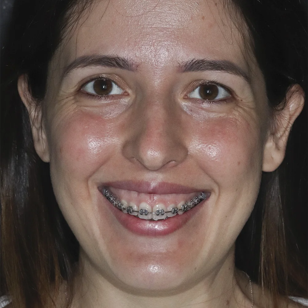 Depois
