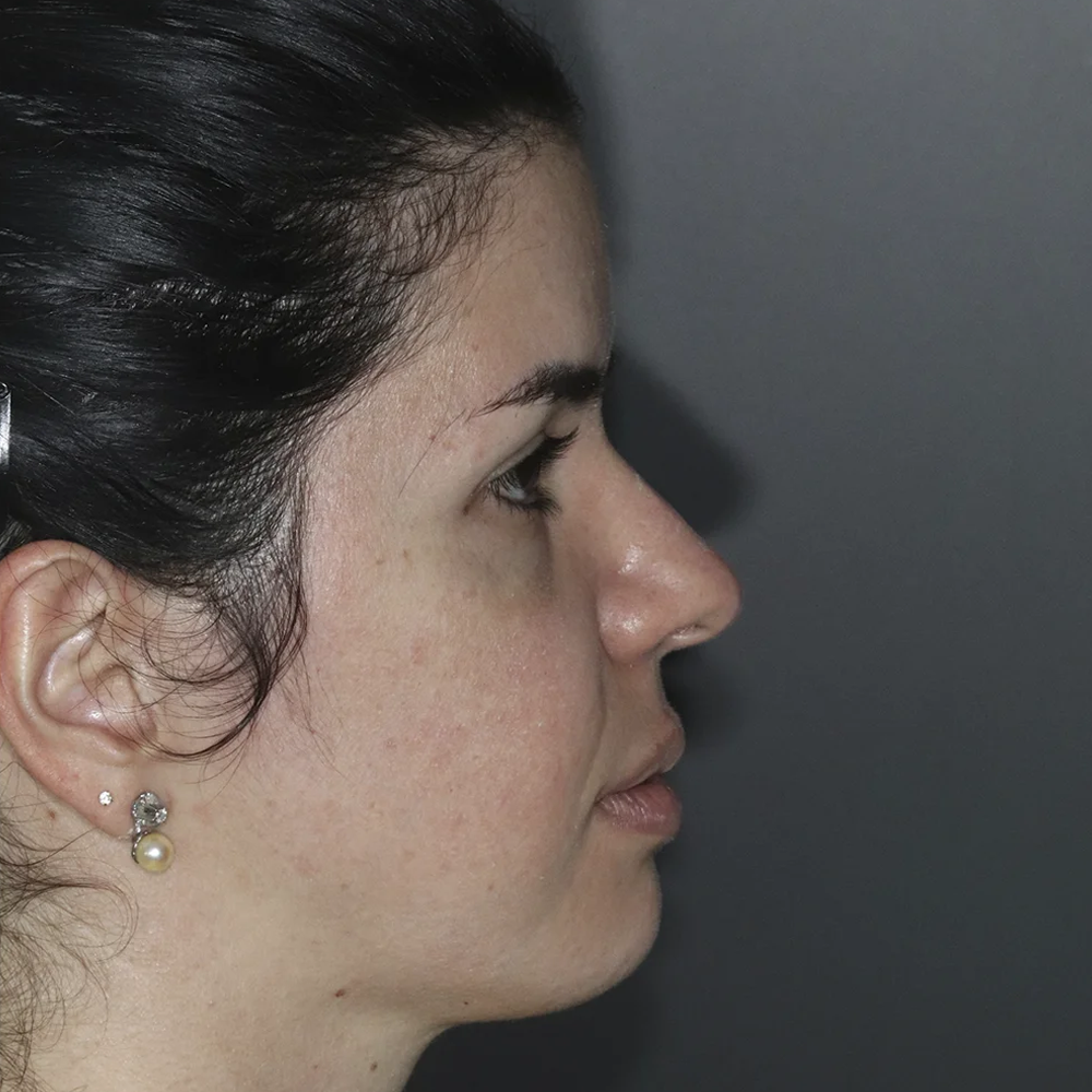 Antes